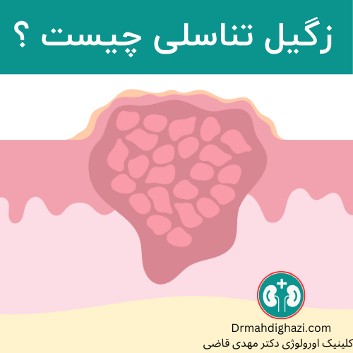 عکس شماتیک زگیل تناسلی در پوست به صورت برش خورده