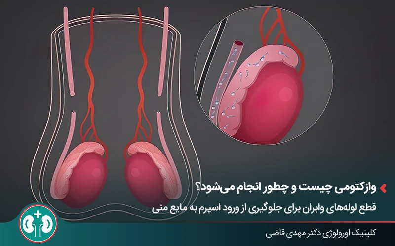 نمای شماتیک دستگاه تناسلی مردان و نحوه قطع لولهها در جراحی وازکتومی