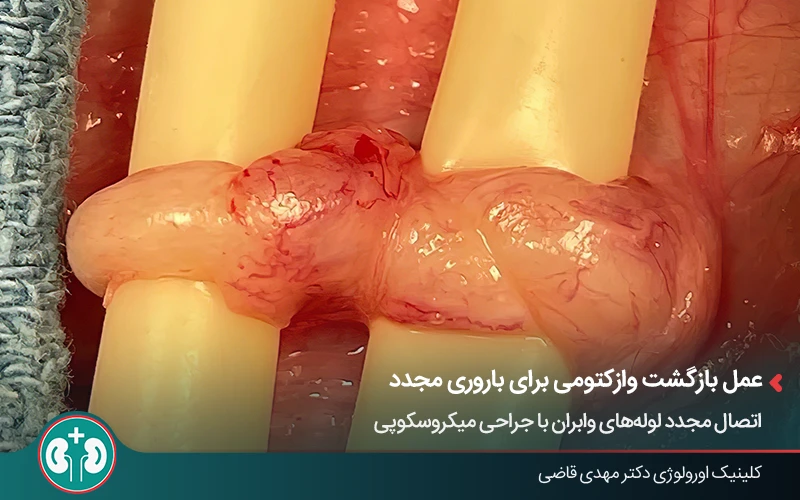 نمایی از جراحی برگشت وازکتومی برای بارداری مجدد