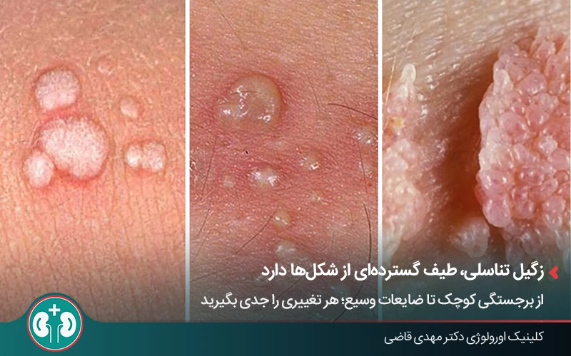 مقایسه ظاهری انواع زگیل تناسلی در بیماران با سیستم ایمنی ضعیف