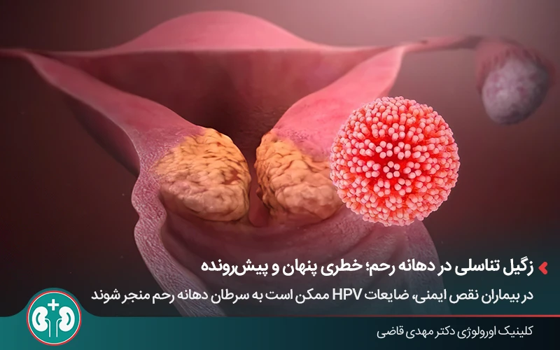 نمایی از پیشرفت زگیل تناسلی به دهانه رحم و خطر ایجاد سرطان دهانه رحم
