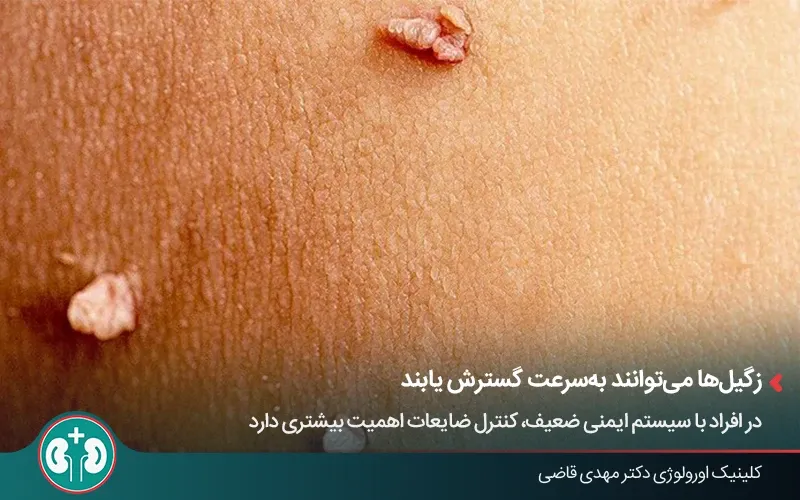زگیل تناسلی روی پوست اطراف ناحیه تناسلی در بیماران نقص ایمنی