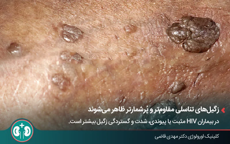 زگیل تناسلی تیره رنگ در ناحیه تناسلی