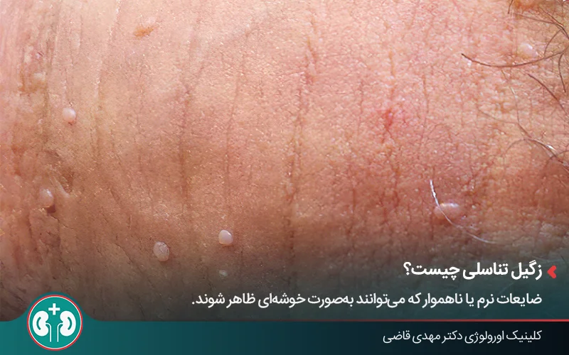 عکس نزدیک از علائم اولیه زگیل تناسلی روی پوست مردان