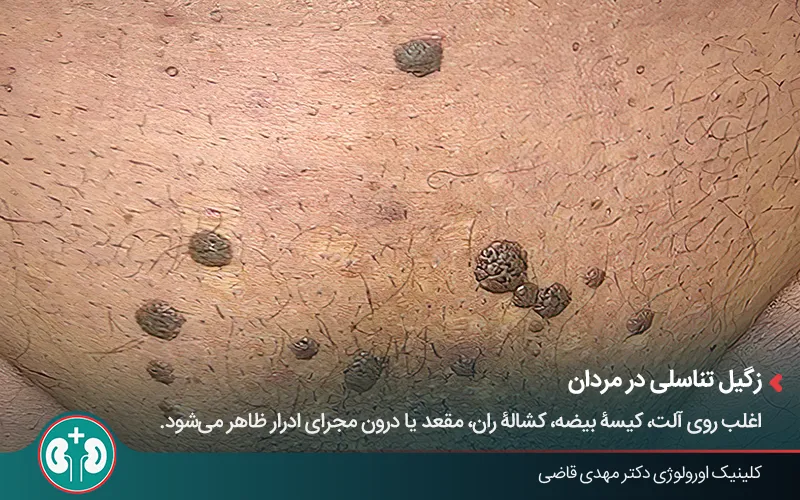 تصویر بالینی از نشانههای زگیل تناسلی تیرهرنگ در مردان