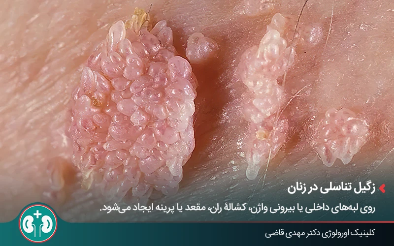 ظاهر زگیل تناسلی در مراحل پیشرفته و خوشهای