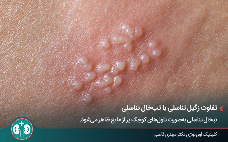 نمای نزدیک از تاولهای تبخال تناسلی روی پوست ناحیه تناسلی
