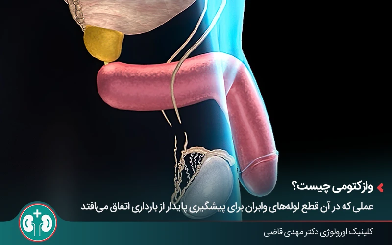 تصویر سهبعدی از فرآیند بستن لوله اسپرماتیک در جراحی وازکتومی