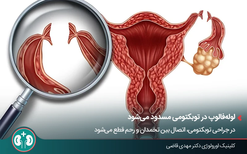 تصویر گرافیکی از روشهای بستن لوله فالوپ در جراحی توبکتومی زنان