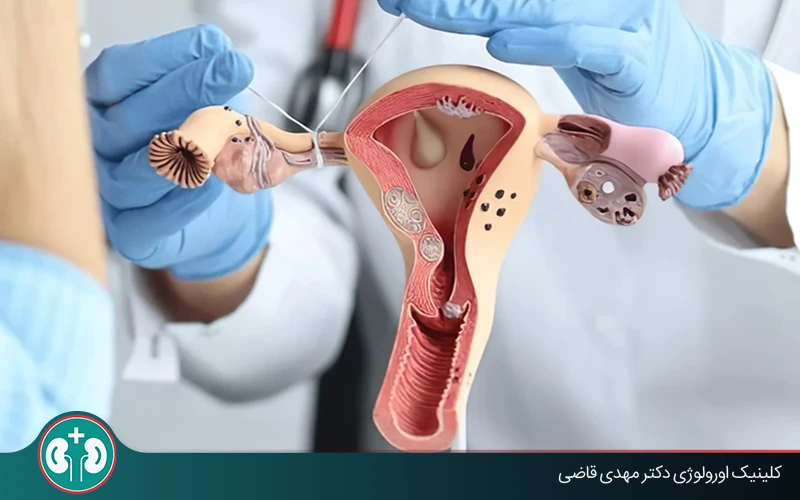 جراحی توبکتومی زنان چیست؟ + مزایا و معایب و عوارض احتمالی