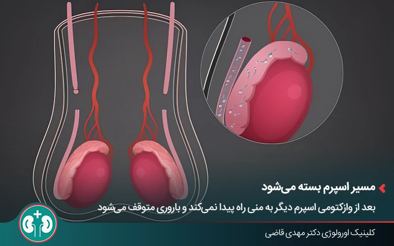 ۹۰ درصد مردان پس از وازکتومی با عارضه جدی مواجه نمیشوند؛ اما بررسی عوارض احتمالی ضروری است