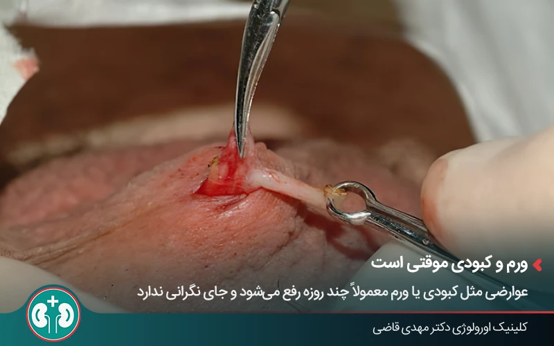مراحل بستن لوله در عمل وازکتومی؛ برشی کوچک برای قطع مسیر اسپرم