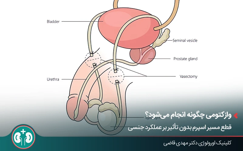 محل قطع لوله واز دفران در عمل وازکتومی