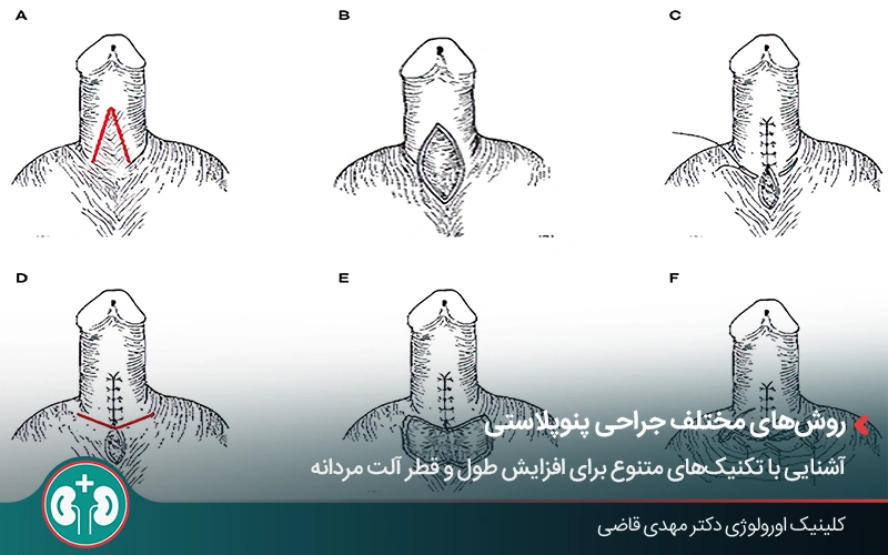 What is Penoplasty 1