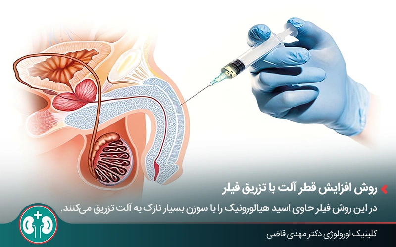 What is Penoplasty 3