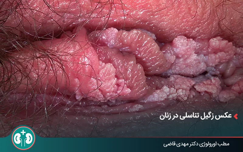 عکس زگیل تناسلی در زنان