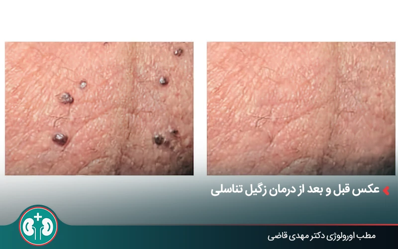 مقایسه عکس قبل و بعد از درمان زگیل تناسلی در ناحیه تناسلی
