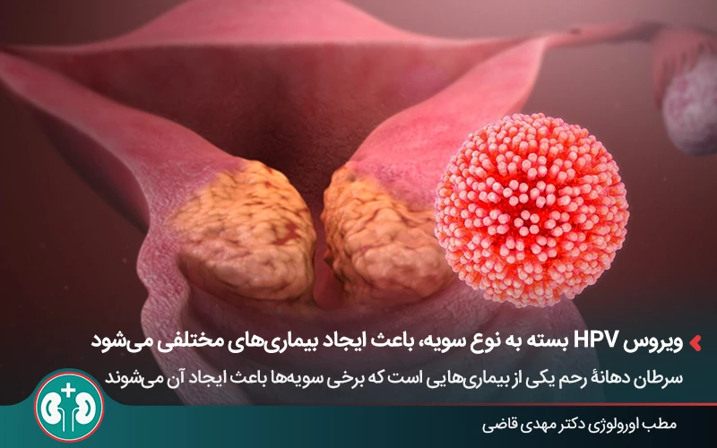 ویروس HPV، عامل ایجاد سرطان دهانه رحم