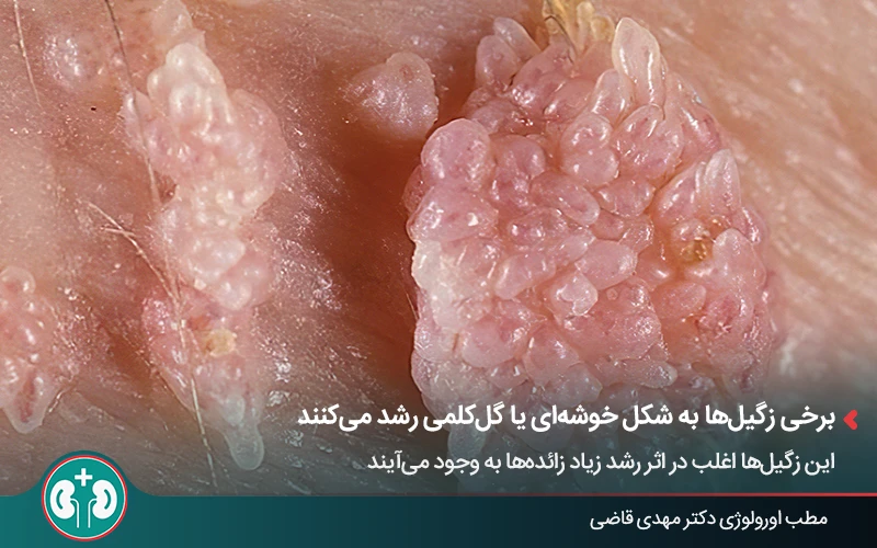 عکس زگیل تناسلی گل کلمی