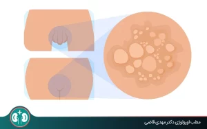 شناخت شکل‌ها و تفاوت‌های انواع زگیل تناسلی؛ عکس و نکات تشخیص