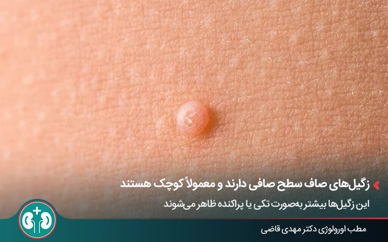 عکس زگیل تناسلی صاف