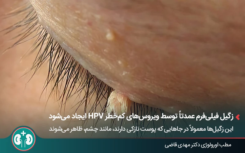 عکس زگیل فیلفرم