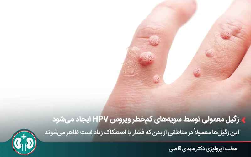 زگیل پوستی روی انگشت دست که شباهت به انواع زگیل تناسلی دارد