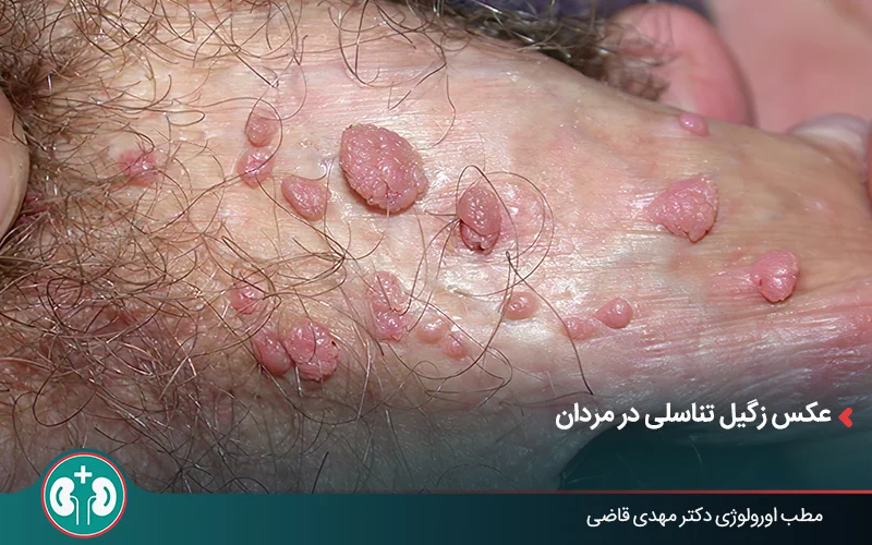 عکس واقعی زگیل تناسلی متعدد در مردان