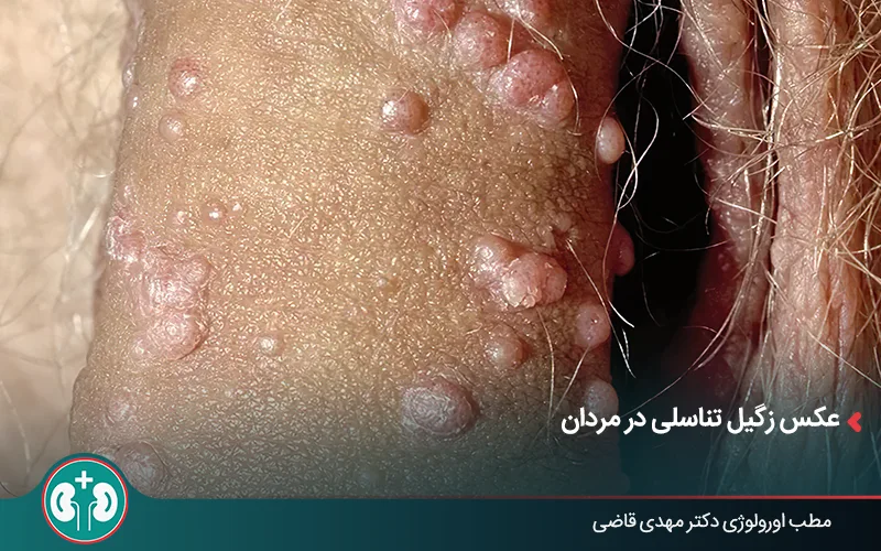 زگیل تناسلی گل کلمی خشن روی آلت تناسلی مرد