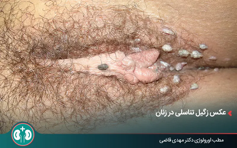 عکس زگیل تناسلی در زنان