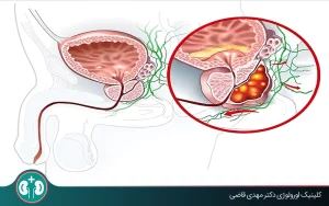 آیا التهاب پروستات باعث سرطان می‌شود؟ بررسی علمی و توصیه‌های پیشگیرانه