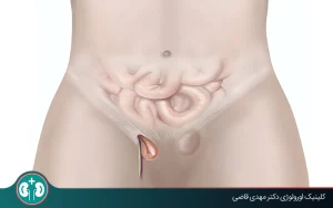 does testicular hernia cause infertility