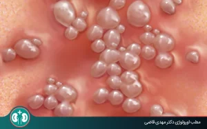 genital herpes recurrence frequency