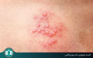 آیا تبخال تناسلی از طریق لباس منتقل می‌شود؟