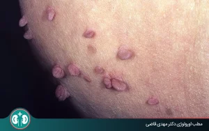 زگیل تناسلی بعد از چند وقت نمایان می‌شود؟ دورۀ نهفتگی و علائم بروز آن