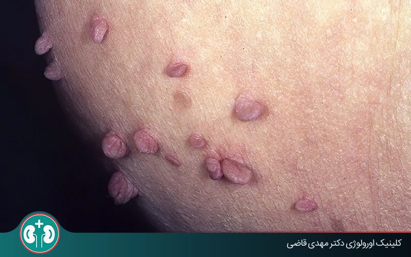 زگیل تناسلی بعد از چند وقت نمایان می‌شود؟ دورۀ نهفتگی و علائم بروز آن
