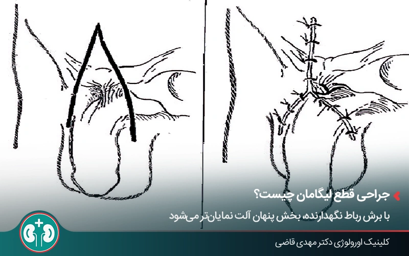 طرح آناتومیکی تصویر قبل و بعد جراحی قطع لیگامان آلت تناسلی و ساختار اتصال آن به استخوان لگن