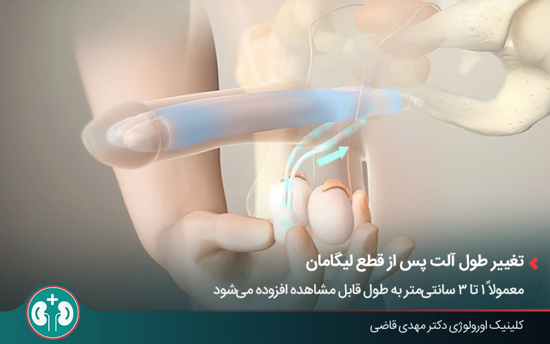 افزایش طول قابل مشاهده آلت بعد از جراحی قطع لیگامان