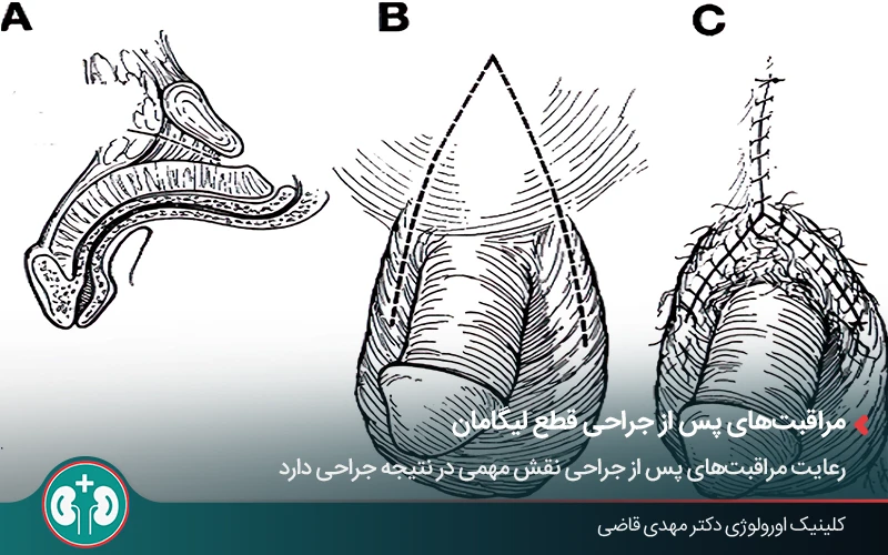 تصویر شماتیک مراحل جراحی قطع لیگامان آلت تناسلی برای افزایش طول