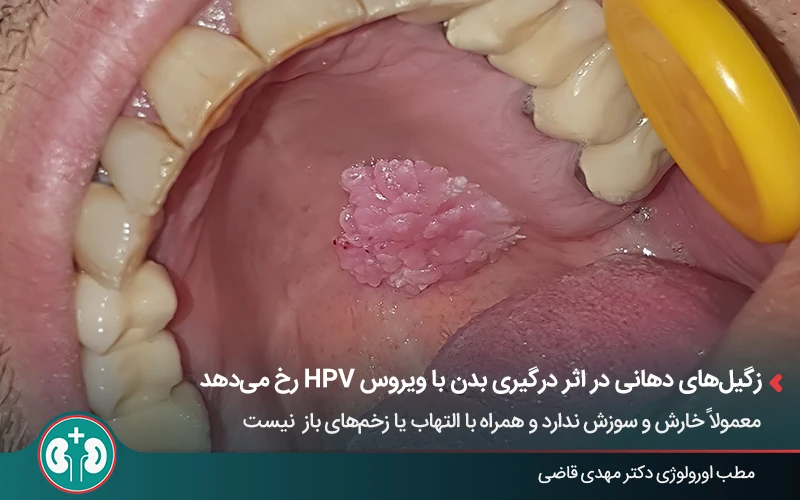 عکس واقعی زگیل تناسلی در دهان و روی زبان