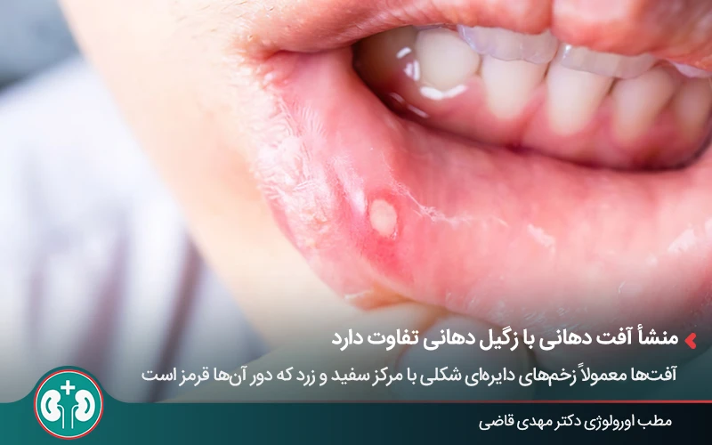 تصویر واضح از آفت دهان روی لب داخلی دهان