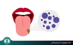 راه های درمان زگیل تناسلی دهان؛ از درمان‌های دارویی تا روش‌های تخصصی