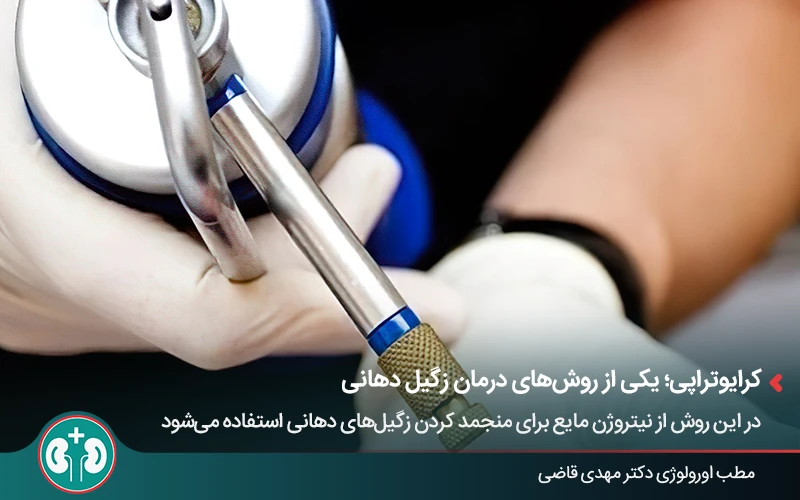 کرایوتراپی، یکی از روشهای درمان زگیل تناسلی دهان