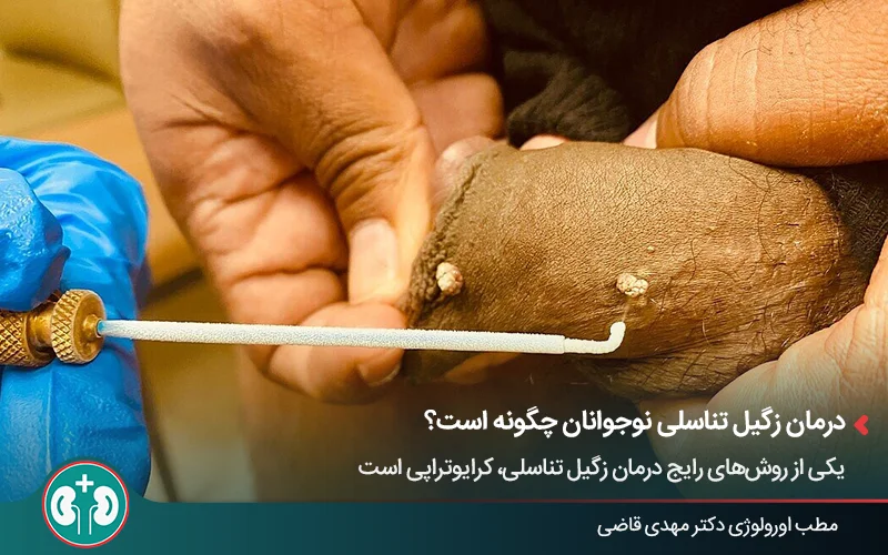 درمان زگیل تناسلی با روش کرایوتراپی