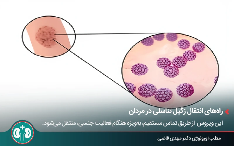 complications genital warts men 4