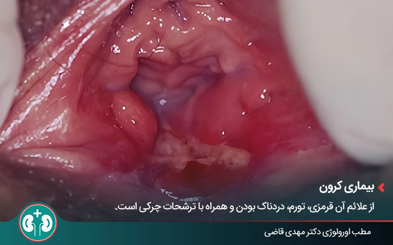 genital skin lesions 10