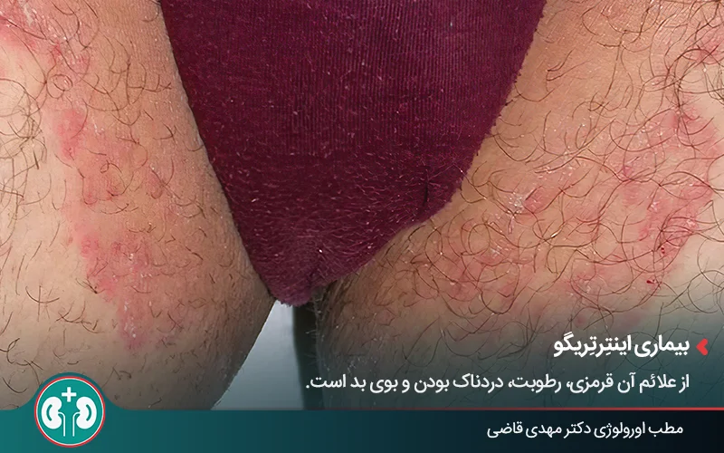 genital skin lesions 11