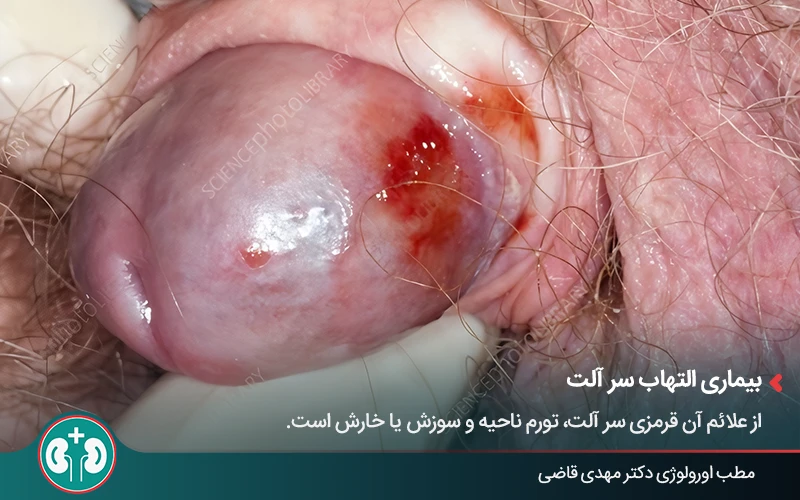 genital skin lesions 12