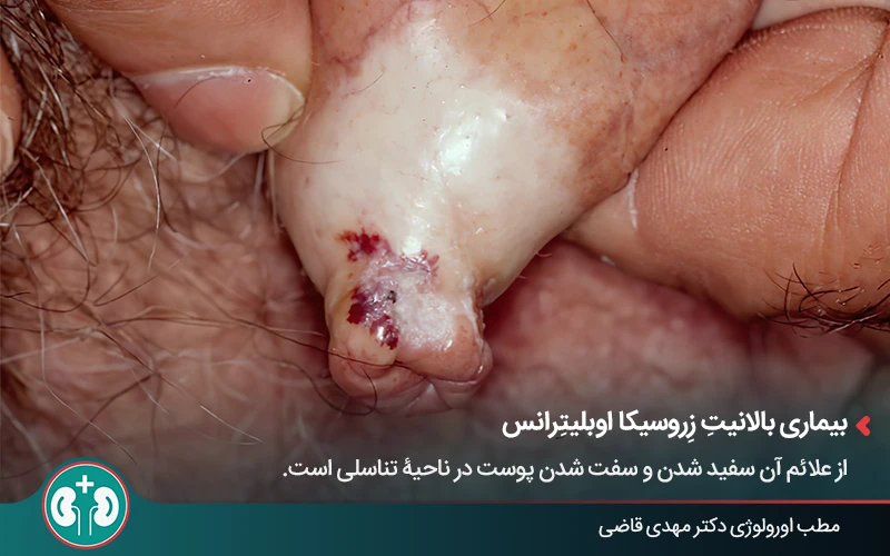 genital skin lesions 13