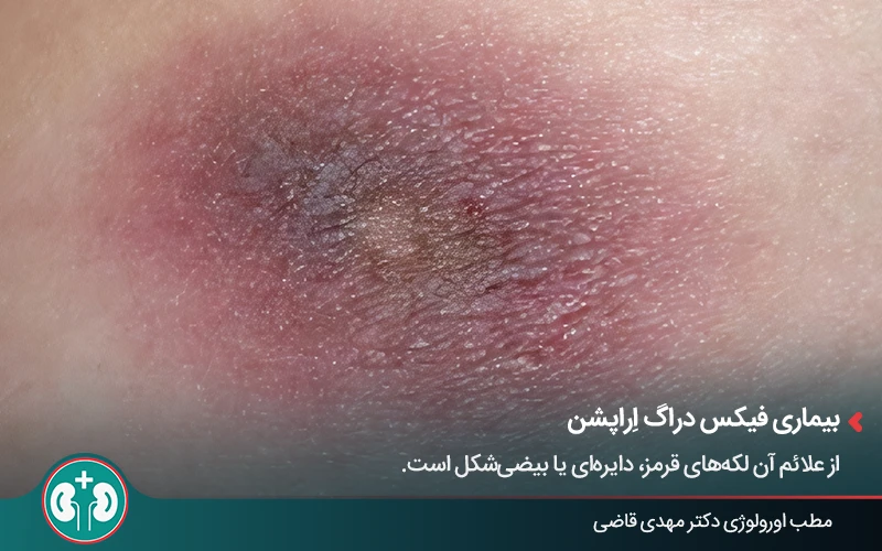 genital skin lesions 15